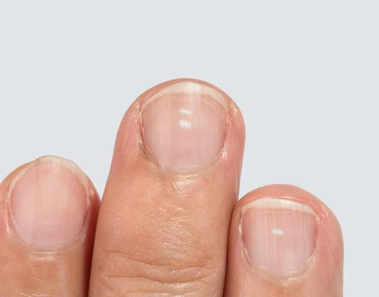 Dit Betekenen Die Witte Vlekjes Op Je Nagels Nieuws Hln Be 