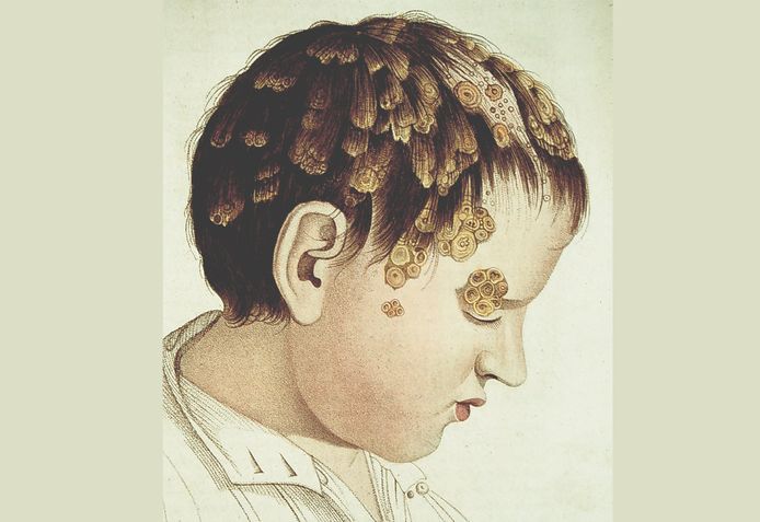 Kind met hoofdzeer, illustratie uit Monographie Des Dermatoses V1, Jean Louis Maria Alibert (1835)