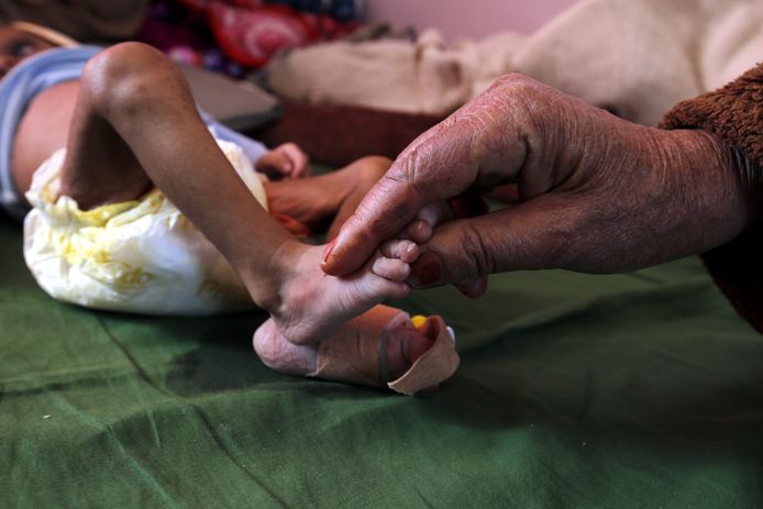 Een vrouw in Jemen houdt de voet vaan haar kleinkind vast. Het kind leidt aan ondervoeding en ligt in een ziekenhuis.