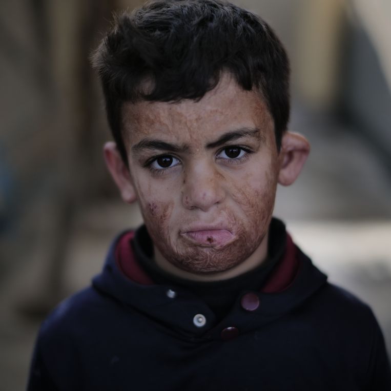 Omar (11) liep tijdens het bombardement op Hawija brandwonden over zijn hele gezicht op. Beeld Bruce Amende