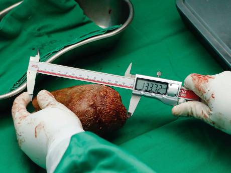 Grootste niersteen ooit weggehaald bij patiënt in Sri Lanka