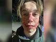 Daaf (19) uit Schijndel nadat hij vorig jaar werd mishandeld op Paaspop.