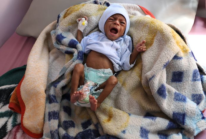 Een zwaar ondervoed kind huilt in een speciale afdeling van het al-Sabeen ziekenhuis in Sanaa, Jemen.
