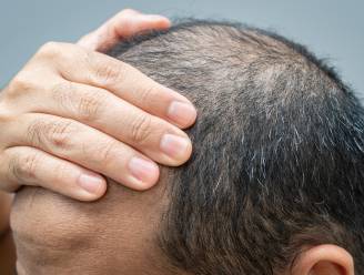 Last van uitdunnend haar? Dermatoloog legt uit wat een ‘galeatomie’ is en hoe effectief dat is