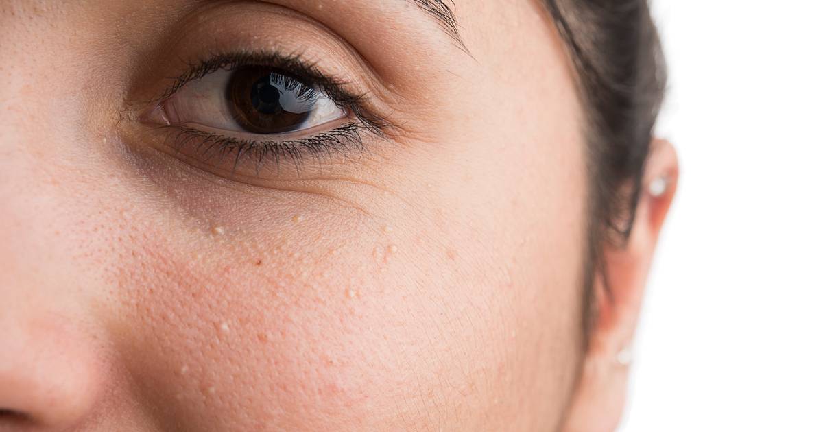 Wat Zijn Die Witte Bolletjes Rond Je Neus En Ogen En Wat Kan Je Er Aan Doen Style Hln Be