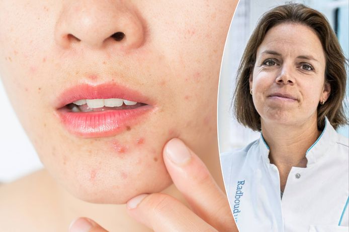 Dermatoloog Rieke Driessen geeft uitleg over acne en wat je ertegen kan beginnen.