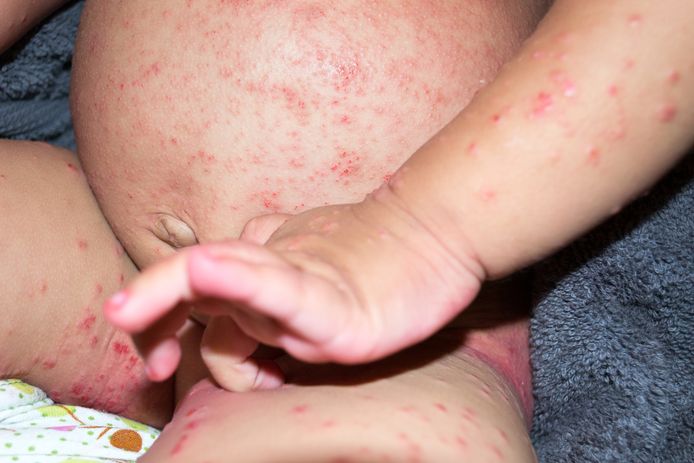 Schurft is een infectie van de huid door de schurftmijt.