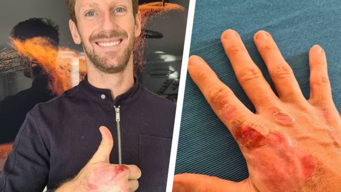 Romain Grosjean dévoile ses brûlures après son terrible crash à Bahreïn