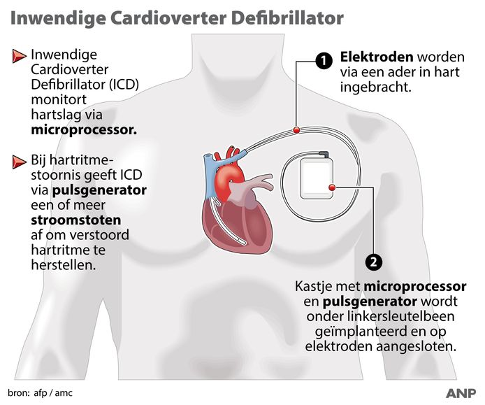 De werking van een Inwendige Cardioverter Defibrillator (ICD).