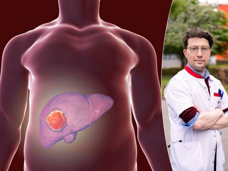 De plus en plus de cancers du foie détectés en Belgique: “La chimiothérapie n’aide pas à combattre cette maladie”