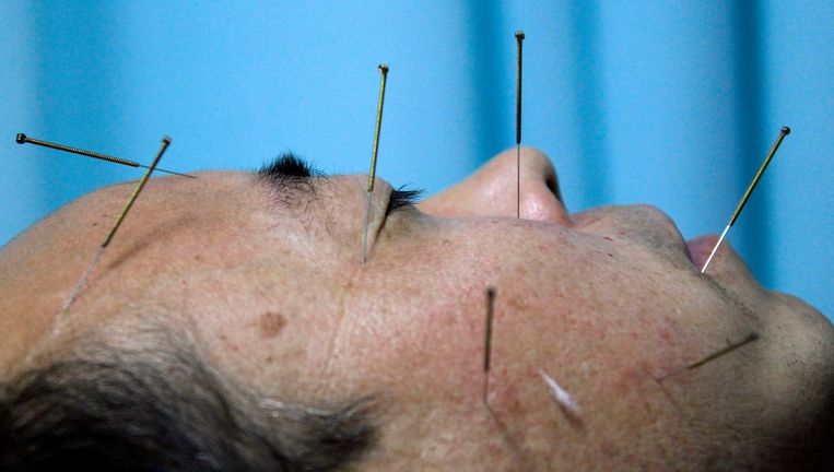 Beter dan acupunctuur? Dat zou zomaar door het placebo-effect kunnen komen. Beeld REUTERS