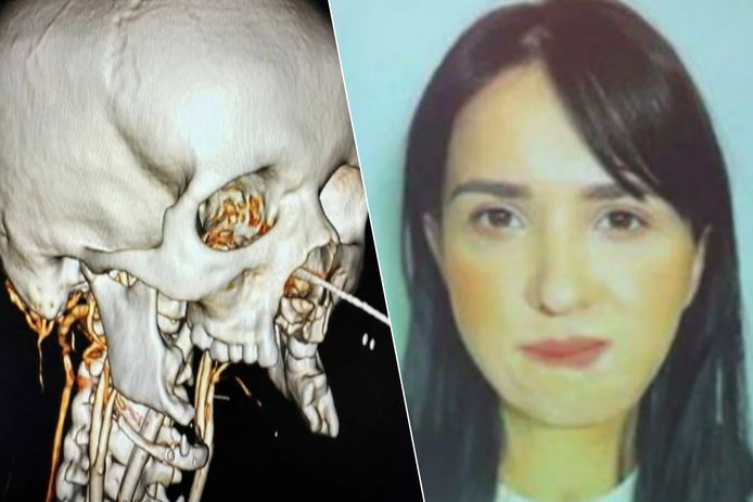Alina Tsoj (rechts) na de reconstructie van haar zwaar gehavende gezicht (links).