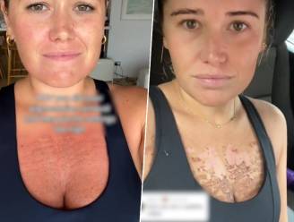 Vrouw toont hoe ze zware brandwonden oploopt door pigmentlaser