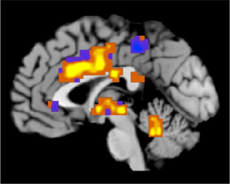 Een hersenscan waarop onderzoeker Tor Wager plekken heeft aangegeven waarop de pijn kan worden waargenomen. Beeld ap