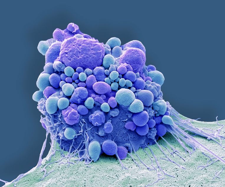 Microscopische foto van een hersenkankercel in een vroeg stadium. Beeld Science Photo Library