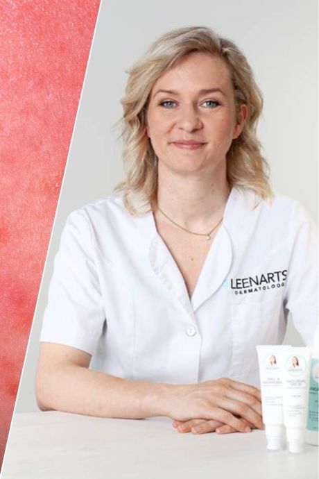 Wat is krentenbaard? Dermatoloog legt uit: ‘De een is er vatbaarder voor dan de ander’