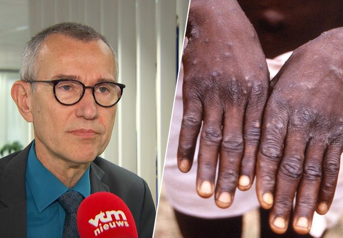 Vandenbroucke: “Besmette personen zullen in contactisolatie moeten gaan totdat de letsels genezen zijn”