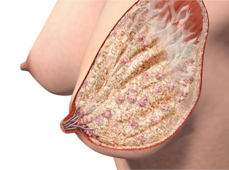 Een meer realistische weergave van de melkklieren in een vrouwenborst, gebaseerd op onderzoek van University of Western Autralia. Beeld Donna Geddes, University of Western Autralia