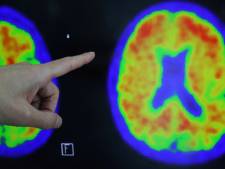Résultats prometteurs pour un nouveau traitement contre Alzheimer