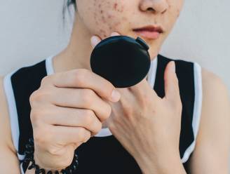 Primeur: gezondheidsinstituut in Verenigd Koninkrijk wil dat mensen met ernstige acne voortaan psychische hulp krijgen