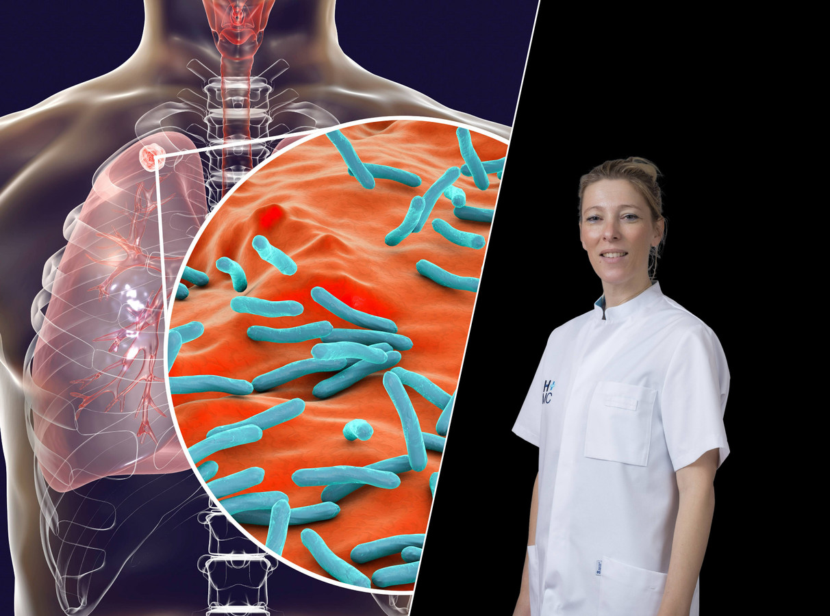 Meer mensen met tuberculose in Nederland: artsen leggen uit hoe deze ...