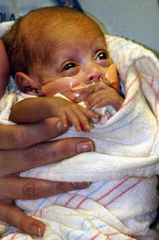 Le Plus Petit Nouveau Ne Du Monde A Aujourd Hui 22 Ans Famille 7sur7 Be