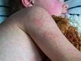 Kun je je als volwassene alsnog laten inenten tegen mazelen? Antwoord op zeven urgente vragen over mazelen