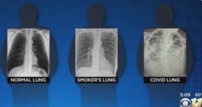 La Radiographie Des Poumons D Un Patient Infecte Par La Covid 19 Ils Sont Dans Un Pire Etat Que Ceux D Un Fumeur Sante 7sur7 Be
