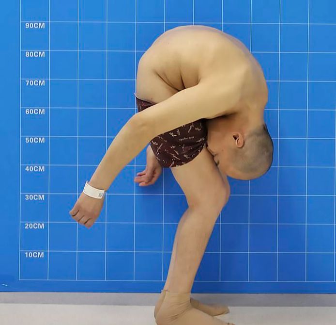 Permanent Gevouwen Chinees Loopt Na Ingrijpende Rugoperaties Eindelijk Weer Rechtop Buitenland Ad Nl