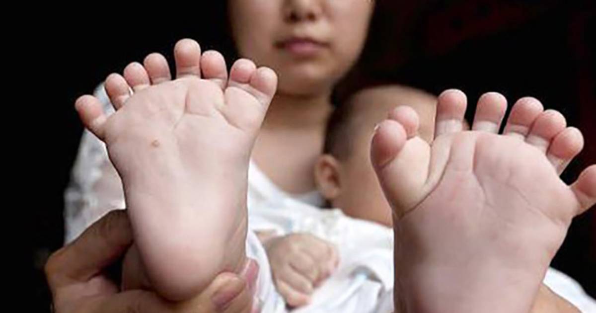 Rekwisieten gesmolten Logisch Baby met 15 vingers en 16 tenen geboren in China | Buitenland | AD.nl