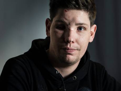 Illegale vuurwerkbom tekent Lars voor het leven: ‘Ik dacht altijd: dit gebeurt mij niet’