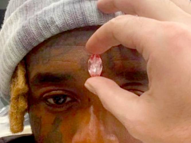 Rapper die roze diamant in voorhoofd liet planten wordt overspoeld door commentaar