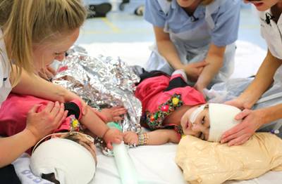 Siamese tweeling na operatie van 50 uur met succes gescheiden