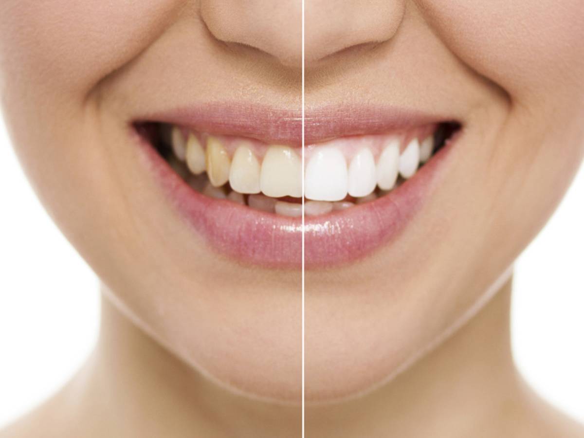 Natuurlijke Methodes Voor Tanden Bleken: Werken Ze Echt? - SoCleanClinic.be thumbnail