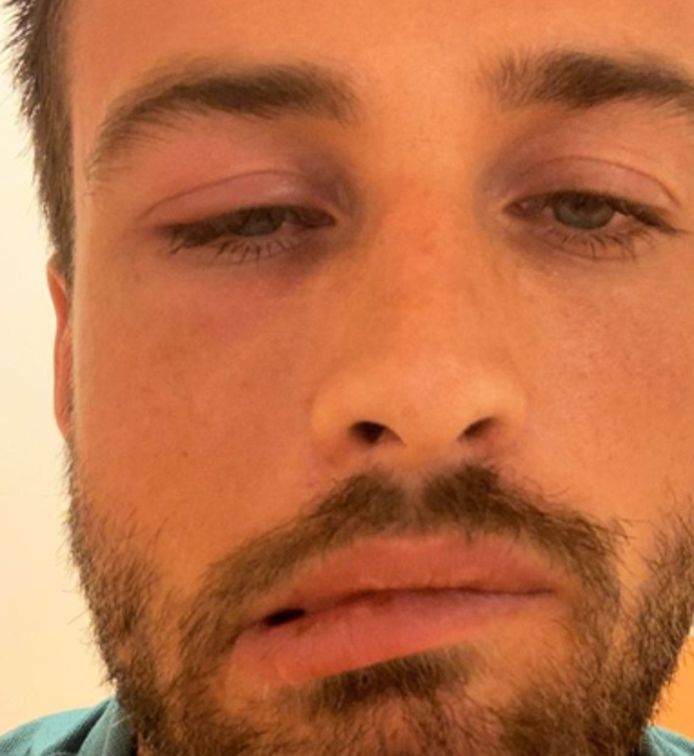 Dave Roelvink had last van zijn gezicht