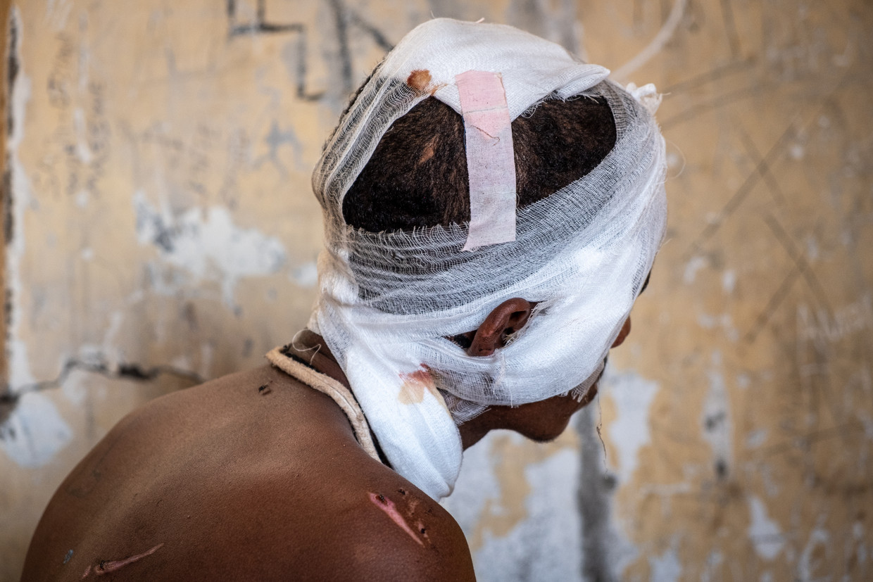 Een gewonde Ethiopische vluchteling in het Um Rakuba-kamp in het oosten van Soedan.