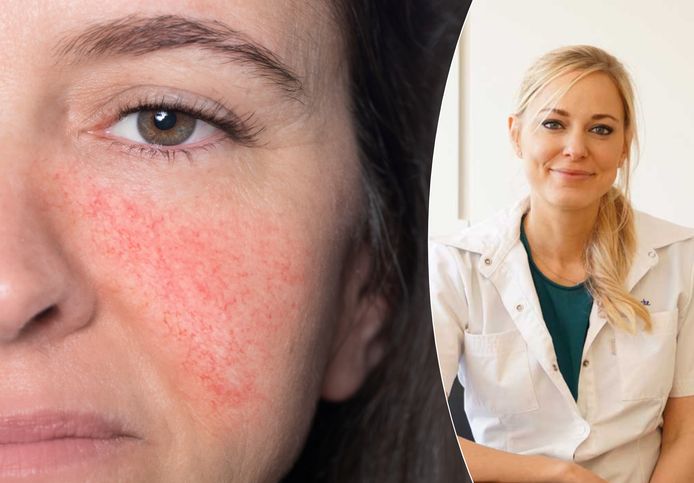 Dermatoloog Stefanie Bracke legt uit wat je kan doen bij couperose.