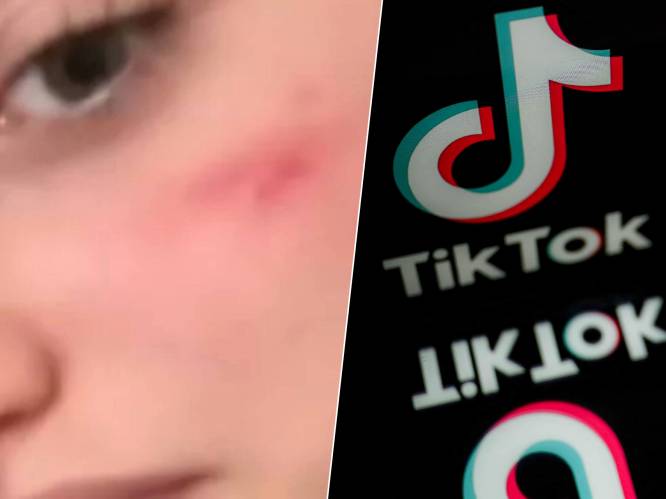 TikTok krijgt miljoenenboete na hype waarbij tieners ‘Frans litteken’ bij zichzelf aanbrengen