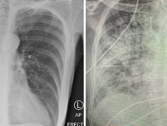 Foto’s tonen schade aan longen na coronabesmetting: “Ziet er slechter uit dan rokerslongen”