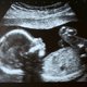 Niet-invasieve test voor genetische aandoeningen foetus