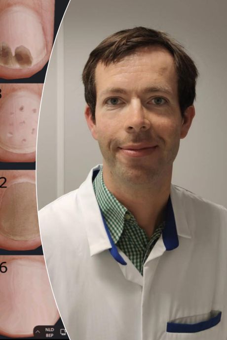 Ce que les taches et fissures sur vos ongles révèlent de votre santé