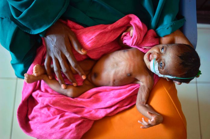 Een zwaar ondervoed kind op de schoot van haar moeder in een UNICEF-ziekenhuis in Somalië.