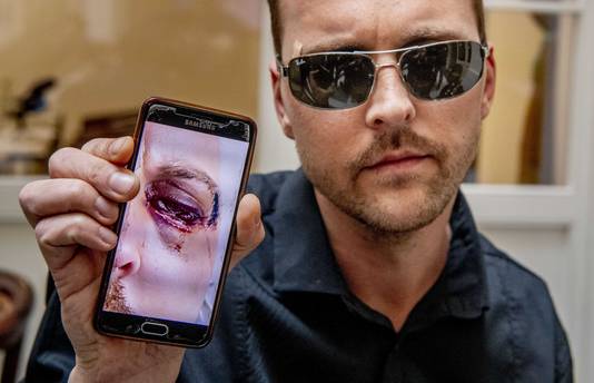 De Praagse ober Mirek van het Polpo restaurant, die is mishandeld door een groep Nederlanders, laat een foto zien van zijn verwondingen. ANP ROBIN UTRECHT