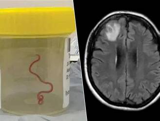 Levende worm gevonden in hersenen van Australische vrouw: “Waarschijnlijk besmet door uitwerpselen python”