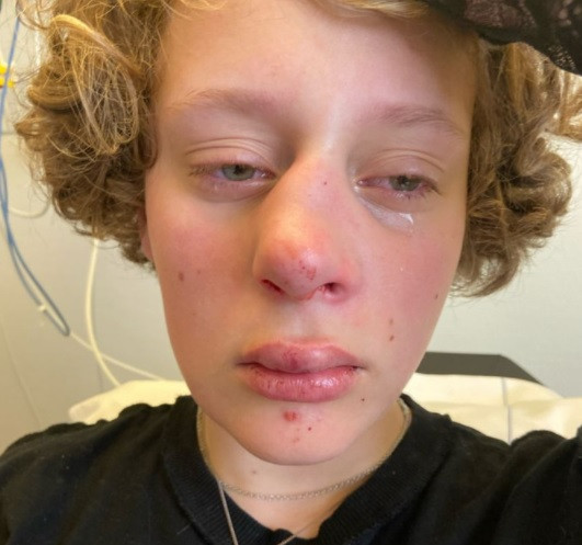 Frédérique (14 ans) a subi plusieurs graves blessures au visage