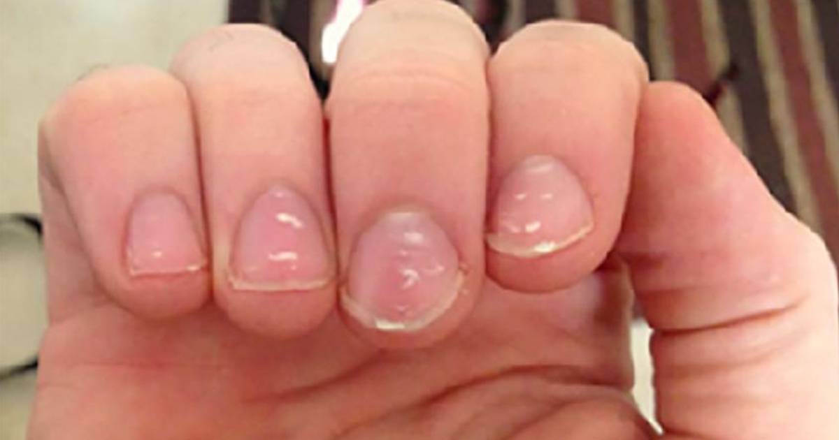 Waarom je soms witte vlekjes op je vingernagels krijgt Weer & Wetenschap hln.be