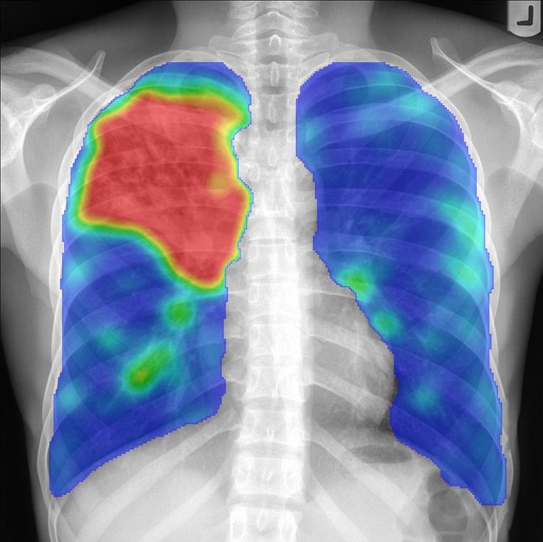 Een patiënt met tuberculose. Op deze afbeelding markeert de AI-software van Thirona in het rood de tbc. Beeld Rein Janssen