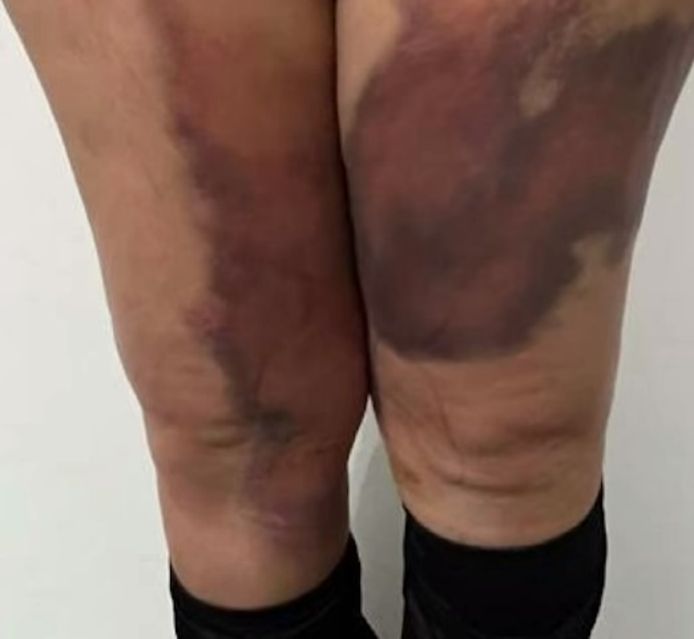 Huge bruises appeared on the legs of Helveh A. (38 years old).