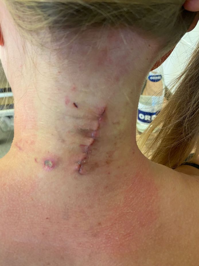 De nek van Valeriya, vlak na haar operatie.