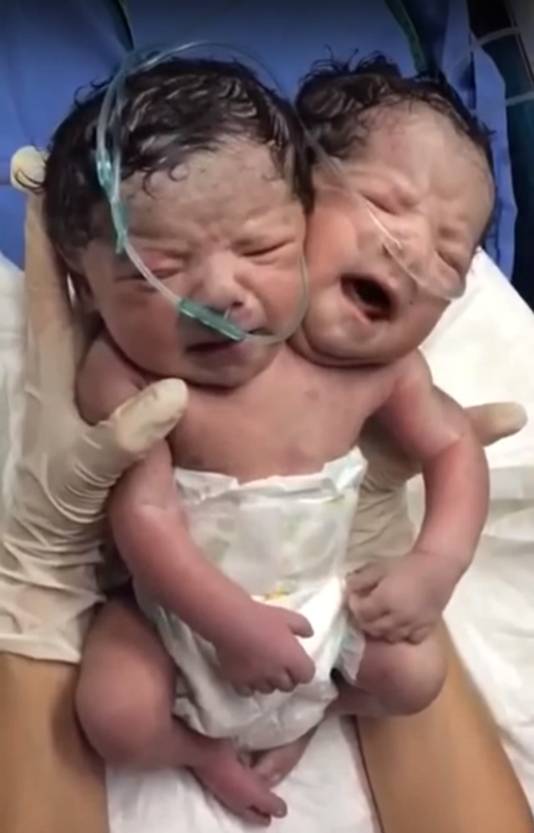 Mexicaanse Baby Met Twee Hoofden Overleden Buitenland Ad Nl